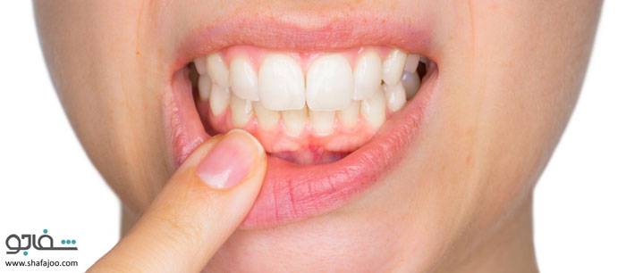 دهان خندقی(ژنژیویت زخمی نکروزدهنده،بیماری ونسان) - trench mouth