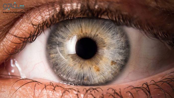 جسم خارجی در چشم - Eye foreign body in