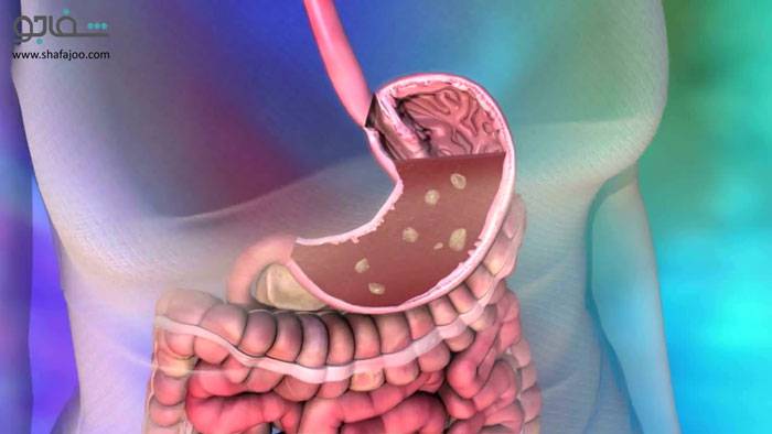 زخم پپتیک (زخم دوازدهه، زخم معده) - ulcer peptic