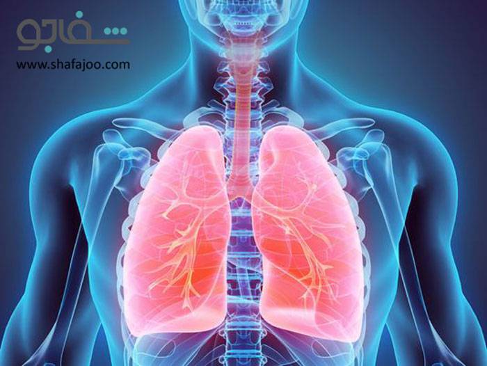 پنومونی مایکوپلاسمایی (پنومونی غیرمعمول) - pneumonia mycoplasmal