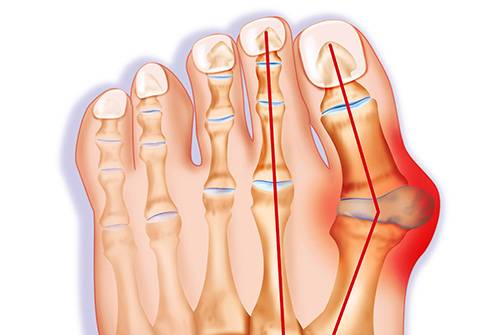 همه چیز درباره زائده استخوانی کنار پا (Bunions)