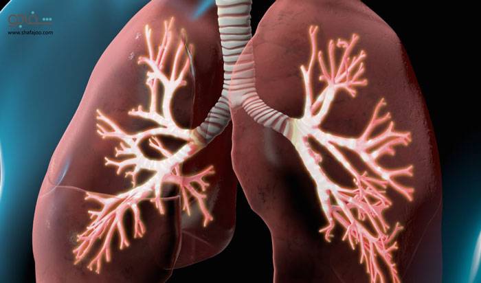 ادم‌ ریه‌ - pulmonary edema