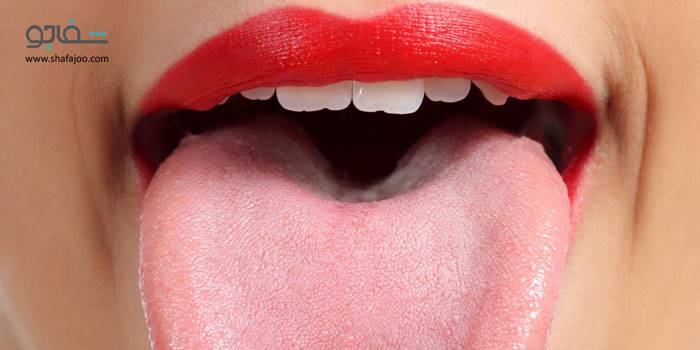 التهاب زبان (گلوسیت) - tongue inflammation
