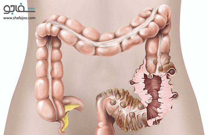بیماری دیورتیکولی - Diverticular disease
