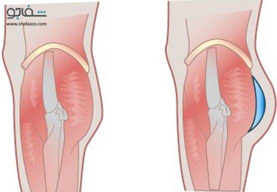 مقایسه تزریق چربی به باسن با پروتز باسن