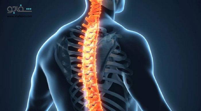 اسکولیوز (انحنای ستون فقرات) - scoliosis