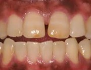 مراقبت از دندانها در دیابت