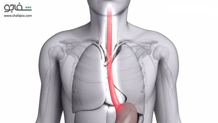 تنگی مری یا ازوفاژیت خورنده - es ophageal str icture or corrosive esophagitis
