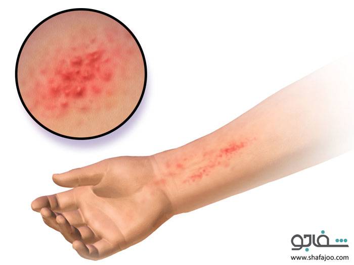 واکنش پوستی آلرژیک به عفونت پوست - واکنش پوستی آلرژیک به عفونت پوست