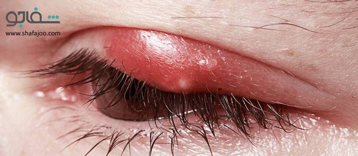 بلفاریت - blepharitis