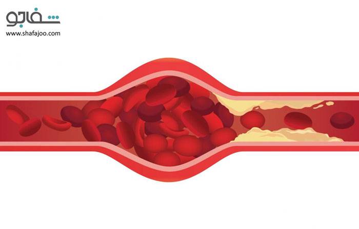 بیماری سرخرگهای قلب(آترواسکلروز سرخرگ های قلب - Cor pulmonale