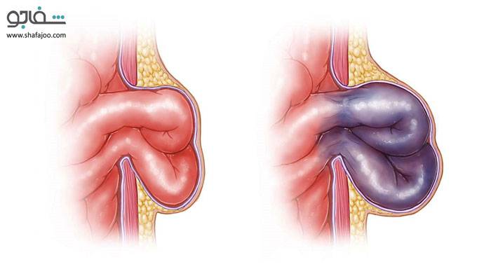 فتق هیاتال - Hiatal hernia