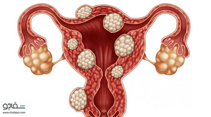 تومورهای فیبرویید رحم - Fibroid tumors of the uterus