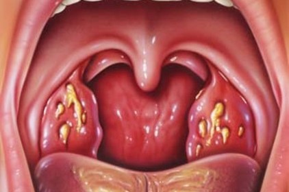 مشکلات لوزه ها و علل نیاز به جراحی لوزه ها