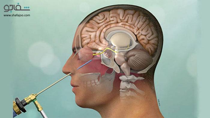 تومورهای هیپوفیز - pituitary tumor