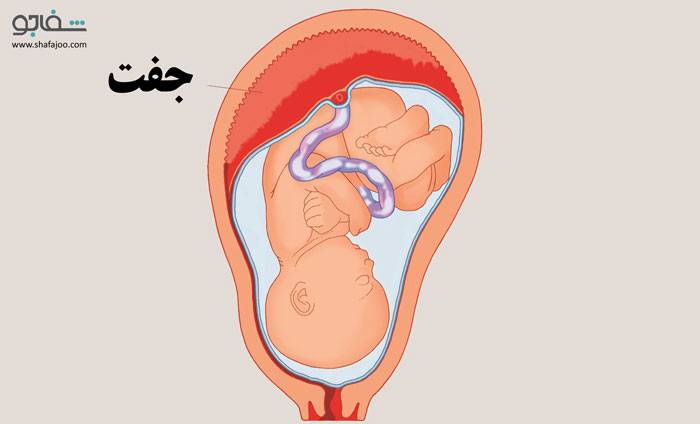 جدا شدن جفت قبل از زایمان - Abruptio placentea