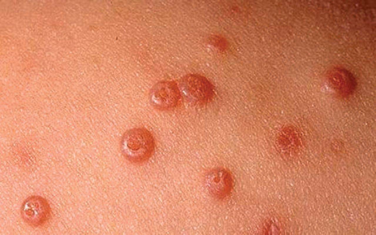 زگیلهای مقاربتی (زگیلهای تناسلی، زگیلهای مرطوب) - warts venereal