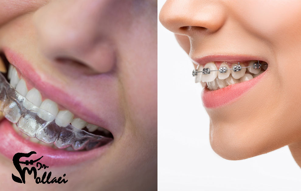 از کجا بفهمیم به ارتودنسی نیاز داریم؟