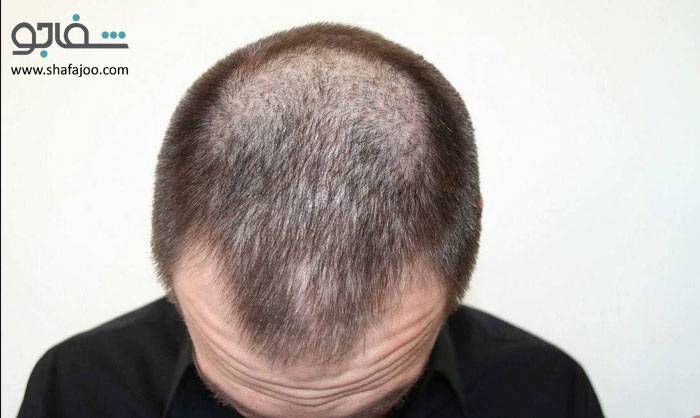 کچلی تغییردهنده رنگ (تینا ورسیکالر) - tinea versicolor