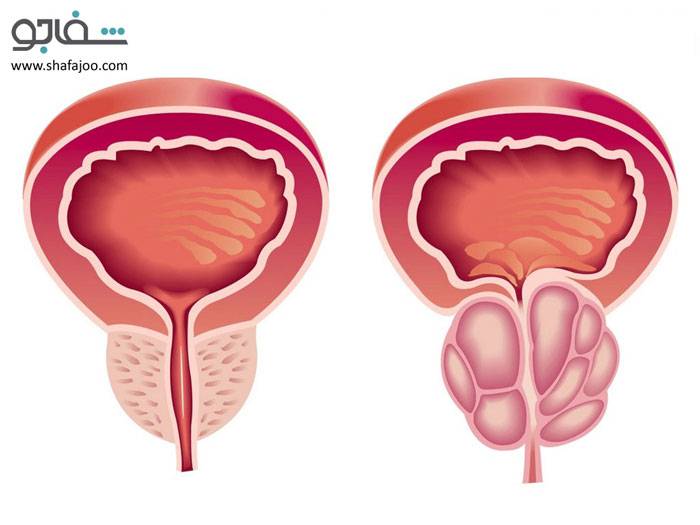 سرطان‌ بیضه‌ - testicular cancer