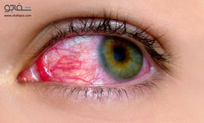 خونریزی زیر ملتحمه - subconjunctival hemorrhage