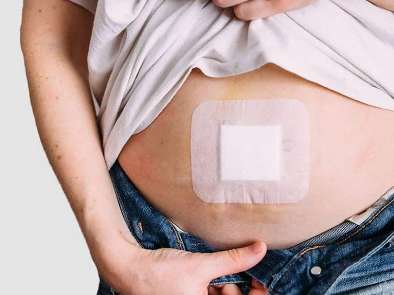چقدر باید برای عمل فتق با لاپاراسکوپی هزینه کنید؟
