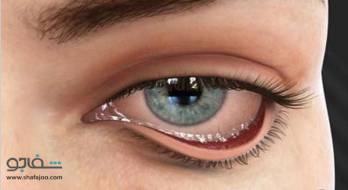 اکتروپیون - Ectropion اکتروپیون - Ectropion