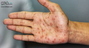 سیفلیس - syphilis سیفلیس - syphilis