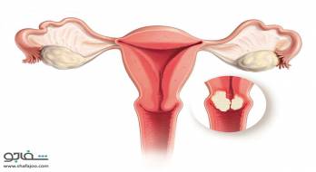 سرطان رحم - uterine cancer سرطان رحم - uterine cancer