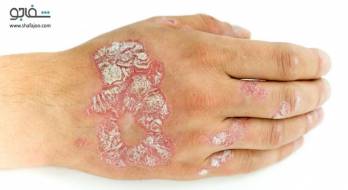 آرتریت مرتبط با پسوریازیس - psoriatic arthritis آرتریت مرتبط با پسوریازیس - psoriatic arthritis