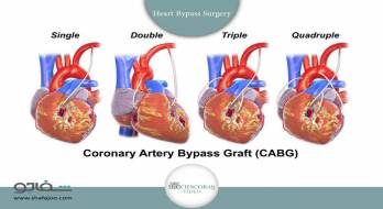 بلاستومیکوز - Blastomycosis بلاستومیکوز - Blastomycosis