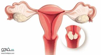 تغییر بافت پوششی گردن رحم - cervical erosion تغییر بافت پوششی گردن رحم - cervical erosion