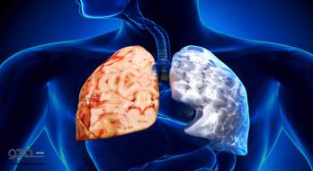 برونشیت مزمن - bronchitis chronic برونشیت مزمن - bronchitis chronic
