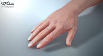 زگیل (وروکا ولگاریس) - warts زگیل (وروکا ولگاریس) - warts