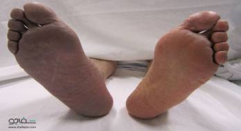 ترومبوز آمبولی شریانی - thrombosis and embolus arterial ترومبوز آمبولی شریانی - thrombosis and embolus arterial