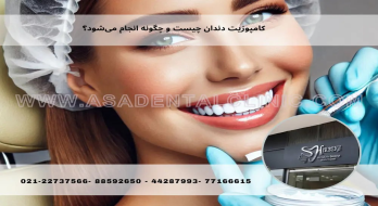کامپوزیت دندان چیست و چگونه انجام میشود؟ کامپوزیت دندان چیست و چگونه انجام میشود؟