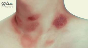 پیتریازیس‌ روزه‌آ - pityriasis rosea