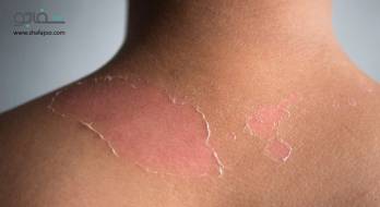 آفتابسوختگی - sunburn آفتابسوختگی - sunburn