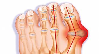 همه چیز درباره زائده استخوانی کنار پا (Bunions)