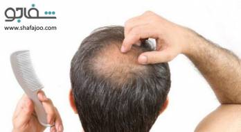 طاسی منطقهای (آلوپسی آرهآتا) - alopecia areata طاسی منطقهای (آلوپسی آرهآتا) - alopecia areata