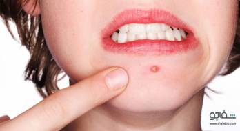 آکنه (جوشهای غرور) - Acne آکنه (جوشهای غرور) - Acne