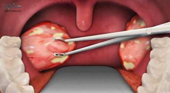 تونسیلیت - tonsillitis تونسیلیت - tonsillitis