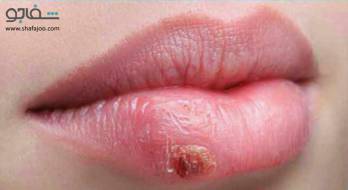 تب خال - cold sore تب خال - cold sore