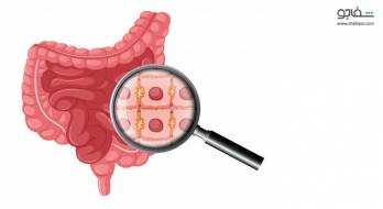 پروکتیت - proctitis پروکتیت - proctitis