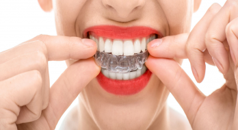 لمینت یا ارتودنسی نامرئی | کدام برای مرتب کردن دندان ها بهتر است؟