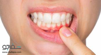 پریودنتیت (التهاب لثه) - periodontitis پریودنتیت (التهاب لثه) - periodontitis