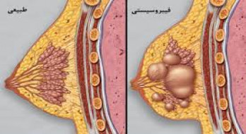کیست های سینه