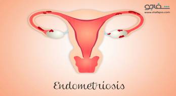 آندومتریوز - Endometriosis آندومتریوز - Endometriosis