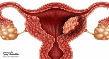 پولیپ‌ گردن‌ رحم‌ - cervical polyps