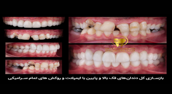 ایمپلنت فوری دندان: راه‌حلی سریع و مؤثر برای بازگرداندن لبخند